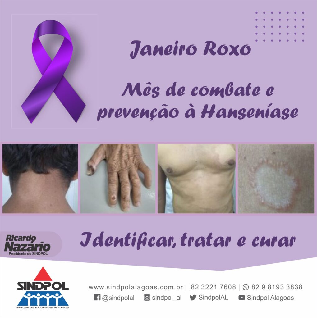 Janeiro Roxo marca o combate à hanseníase - Secretaria da Saúde